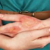 Açıq yaralar haqqında