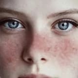 Sistem qırmızı qurdeşənəyi (lupus)