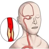 Karotis Stent: Karotis Arteriyalarının Açılması və Xəstəliklərin Müalicəsi