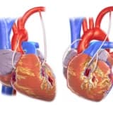 Aortokoronar şuntlama xesteliyi