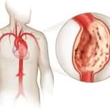 Arterial və venoz anevrizmalar