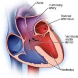 Trunkus Arteriyozus