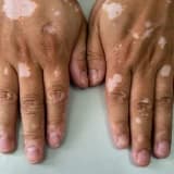 Vitiligo Xəstəliyi: Səbəbləri, Simptomları və Müalicə Yolları