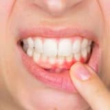 Diş əti iltihabı: müalicə, səbəblər və profilaktik tədbirlər