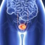 Sidik kisəsi xərçəngi nədir?