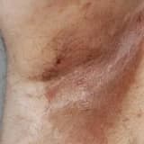 Eritrazma