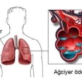 Ağ ciyərin ödemi