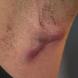 Hidradenitis Suppurativa və Qidalanma: Köpək Döş Xəstəliyində Diyetin Əhəmiyyəti