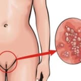 Urogenital papillomavirus infeksiyası (iti uclu kondilomalar)