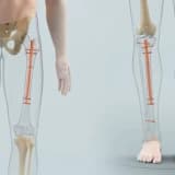 Uşaqlarda və Yetkinlərdə Boy Uzatma Cərrahiyyəsi