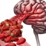 Arteriovenoz Malformasiya (AVM): Tərif, Səbəbləri və Müalicə Yolları