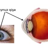 Eksimer Lazer Cərrahiyyəsi