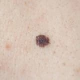 Melanoma