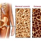 Osteoporoz xesteliyi