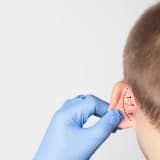 Otoplastika: Qulaq Estetikası