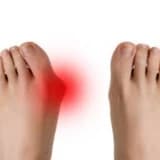 Hallux valgus ağrısı