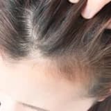 saç xəstəlikləri