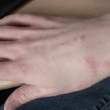 Parazitar xəstəliklər