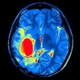 Beyin Şişi Cərrahiyyəsi: Həyat Xilasedici Müdaxilələr
