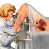 Vulvanın biopsiyası