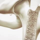 OSTEOPOROZ / OSTEOPOROZ NƏDİR / DİAQNOZ NECƏ QOYULUR?