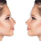 Septoplastika əməliyyatı
