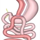 Mini Qastrik Bypass