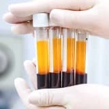 PRP (Platelet Rich Plasma - Trombositden Zəngin Plazma) nədir?