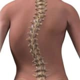 Skolioz nədir? Necə başa düşmək olar?