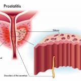Prostatit: Prostat Vəzinin İltihabı
