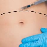 Qarın Germe Əməliyyatı: Abdominoplastika
