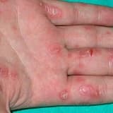 Cinsi yolla keçən zöhrəvi xəstəliklər (Venerologiya )