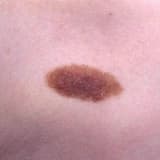 Nevus (Xal)