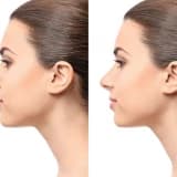 Burun Estetikası (Rinoplastika)