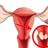 Rahim Ağzı Kanseri Ile Ilgili Bilmeniz Gereken 8 Gerçek!