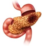 Qaraciyər Xərçənglərində Ablation
