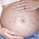 Hamiləlik Pemfikoidi: Hamiləlik zamanı görülən bir dəri xəstəliyi