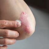 Psoriaz haqqında
