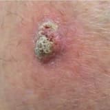 Yastıhüceyrəli Dəri Xərçəngi