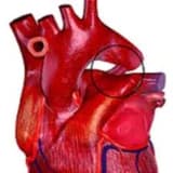 Açıq arterial axacaq
