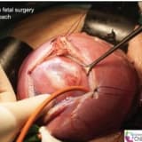 Fetal cərrahi müdaxilələr