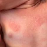 Dermatit