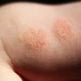 Allergik dəri xəstəlikləri (atopik ekzema, kontakt ekzema, kosmetik allergiya)