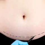 Endoskopik Abdominoplastika: Minimal Çapıqlarla Mükəmməl Qarın Estetiği