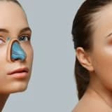 Rinoplastika (Burun əməliyyatı) haqqında