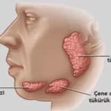 Tüpürcək vəzi xərçəngi