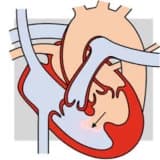 Aorta-Pulmoner pencere