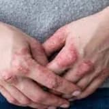 Psoriatik artrit