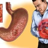 Qastrit: mədə iltihabı və simptomları