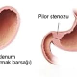 Uşaqlarda pilor stenozu: İlk 3 ayda qusma səbəbləri,Mədə çıxışı darlığı